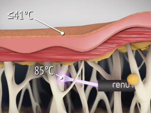 Illustration: Renuvion working on skin layers