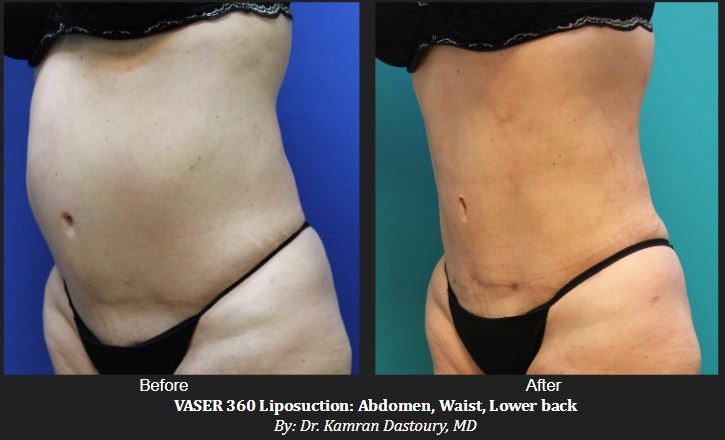 Before and After Photos: Advanced VASER 360 Liposuction of abdomen, waist, and lower back in Denver CO
