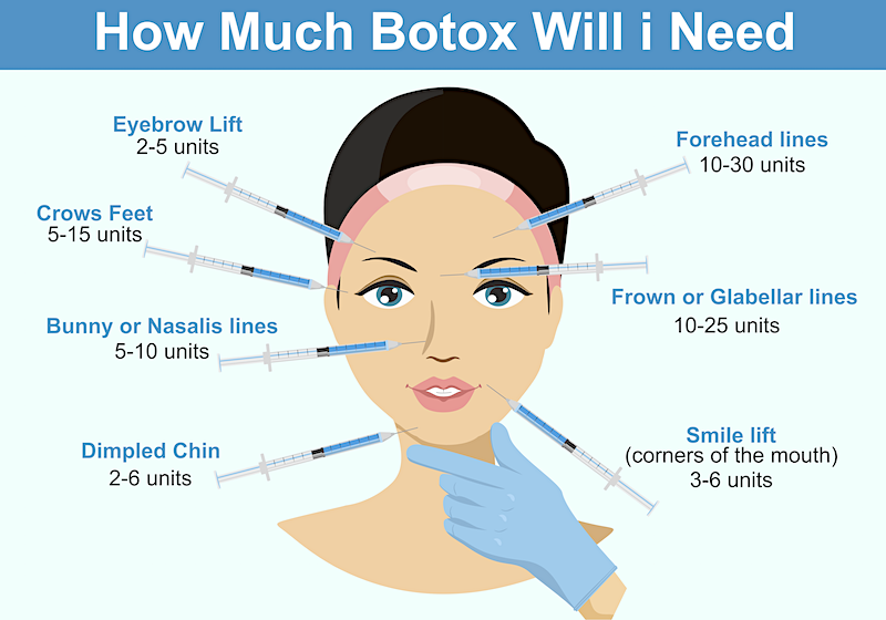 Graphic showing how much Botox is needed for specific wrinkles