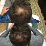 Before and After Hair Regeneration