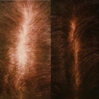Before and After Hair Regeneration Photo