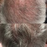 Image of Before and After Hair Regeneration