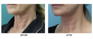 Modern Neck Lift Before and After