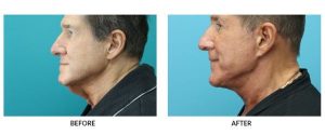 Traditional Neck Lift Before and After