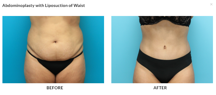 Before and After Tummy Tuck